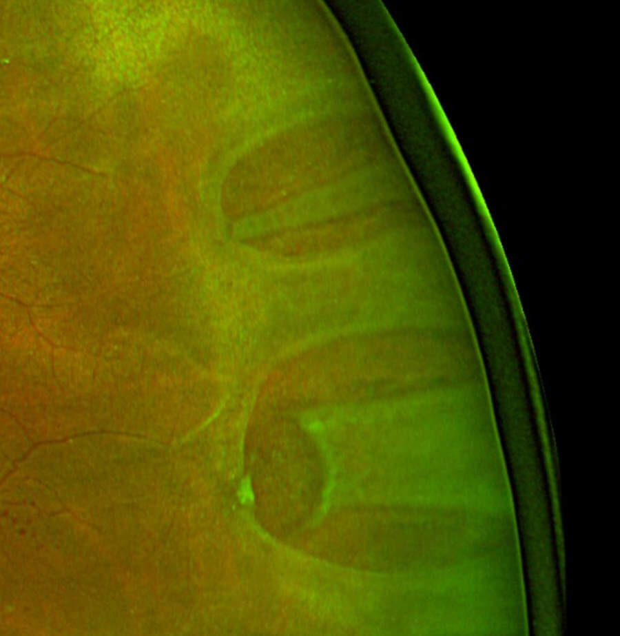 Fundus photograph of a horseshoe tear associated with retinal detachment.