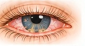 Illustration of eyelid-margin inflammation