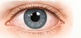 Illustration of a chalazion