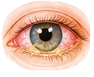 Illustration of a red eye with conjunctival discharge