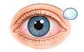 Illustration of a contact lens and red eye