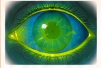 Illustration of a corneal surface injury