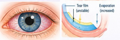 Illustration of an unstable tear film and dry eye