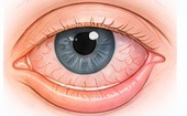 Illustration of an outward-turning lower eyelid