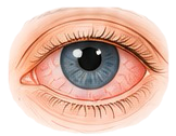Illustration of an inward-turning eyelid with lashes touching the eye
