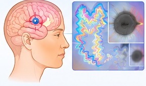 Illustration of visual phenomena associated with migraine aura