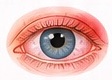 Illustration of a red, painful eye