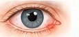 Illustration of a hordeolum, or stye