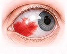 Illustration of a subconjunctival haemorrhage
